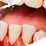 با این دهانشوی خونگی خونریزی دندونت رو تو کمتر از 60 ثانیه بند بیار